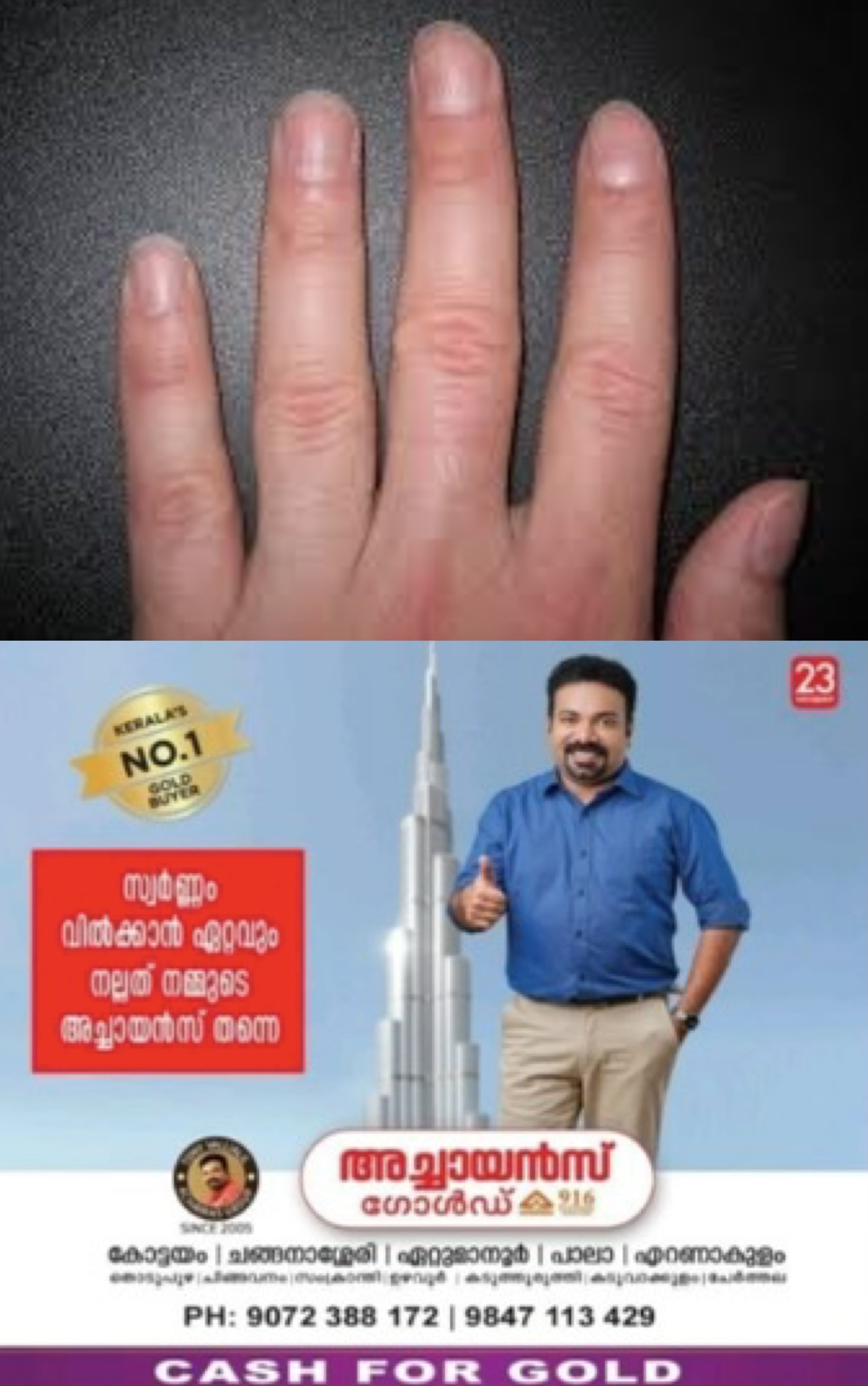നഖങ്ങളിൽ മഞ്ഞ നിറമോ പൊട്ടലുകളോ ഉണ്ടോ? നിസാരമായി തള്ളിക്കളയരുത്