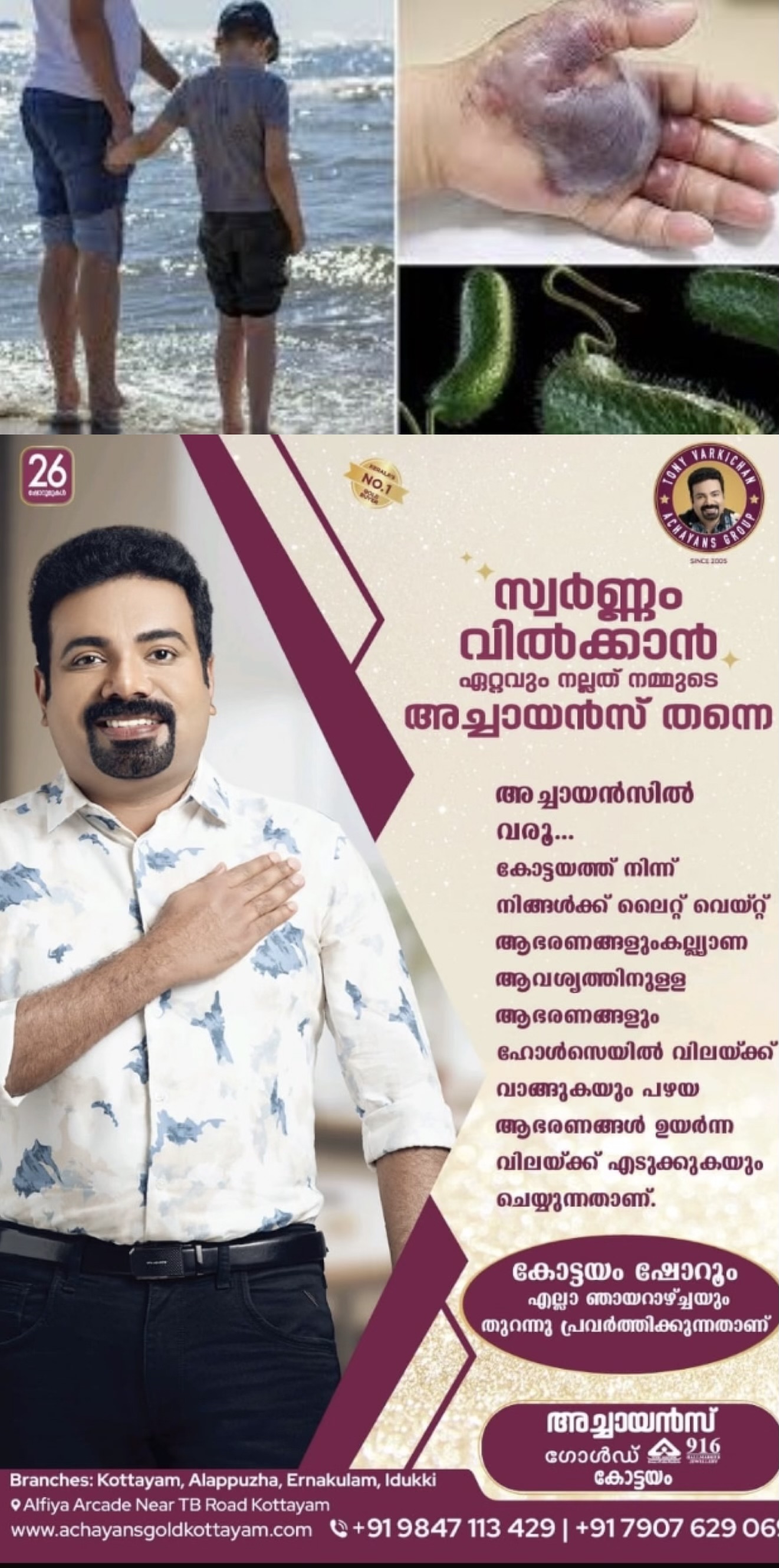 മാംസം ഭക്ഷിക്കുന്ന ബാക്ടീരിയ; 11 പേര്‍ക്ക് സംസ്ഥാനത്ത് അണുബാധ സ്ഥിരീകരിച്ചതായി ആരോഗ്യവകുപ്പ്