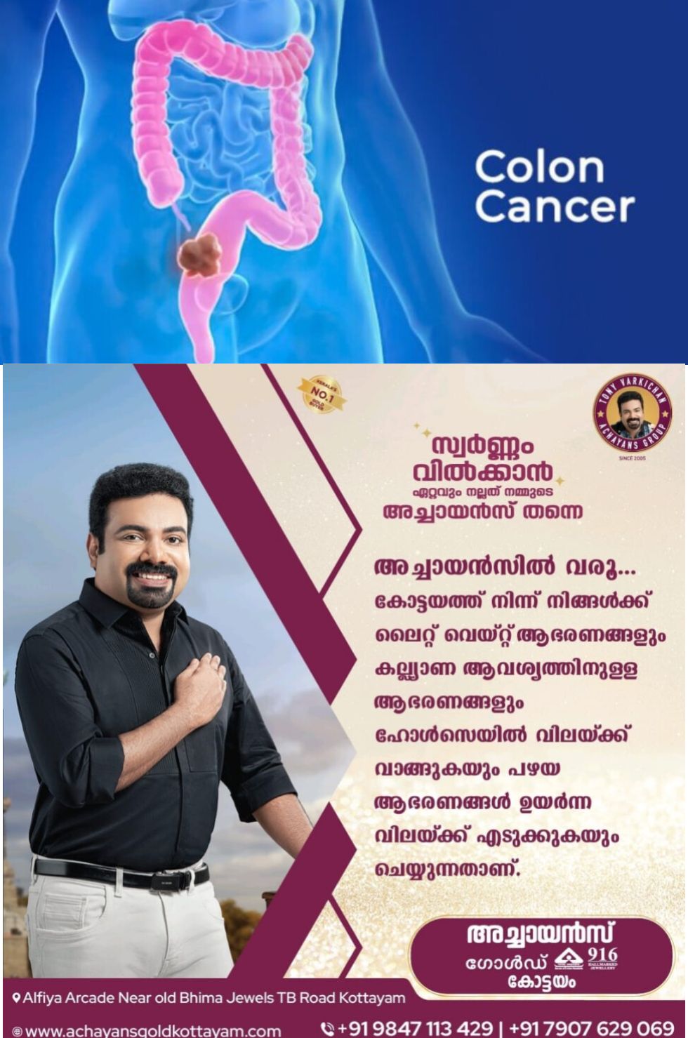 *കൂടുതൽ ആൾക്കാർ മരിക്കുന്നതിന് കാരണമാകുന്ന കാൻസറാണ് കോളൻ കാൻസർ ഈ രോഗത്തെ കുറിച്ച് അറിയാം*